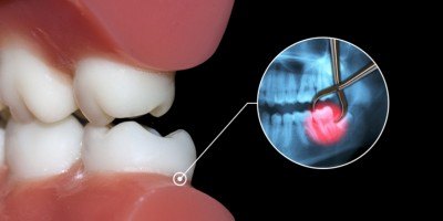 Lesson 3: The Periodontium